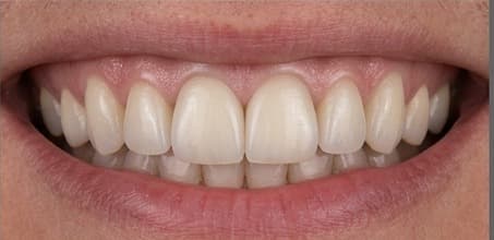 After treatment