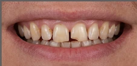 Before treatment